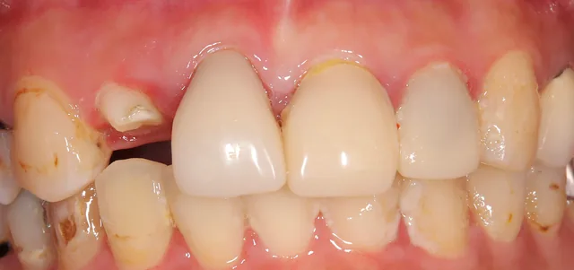 前歯の見た目を自然に整えたe-max症例 治療前