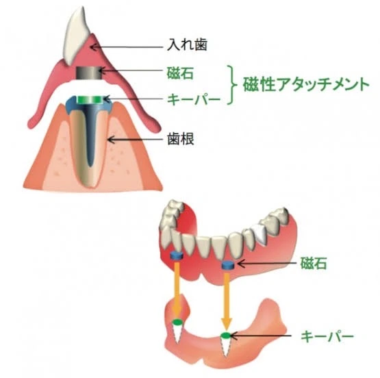 アタッチメント義歯