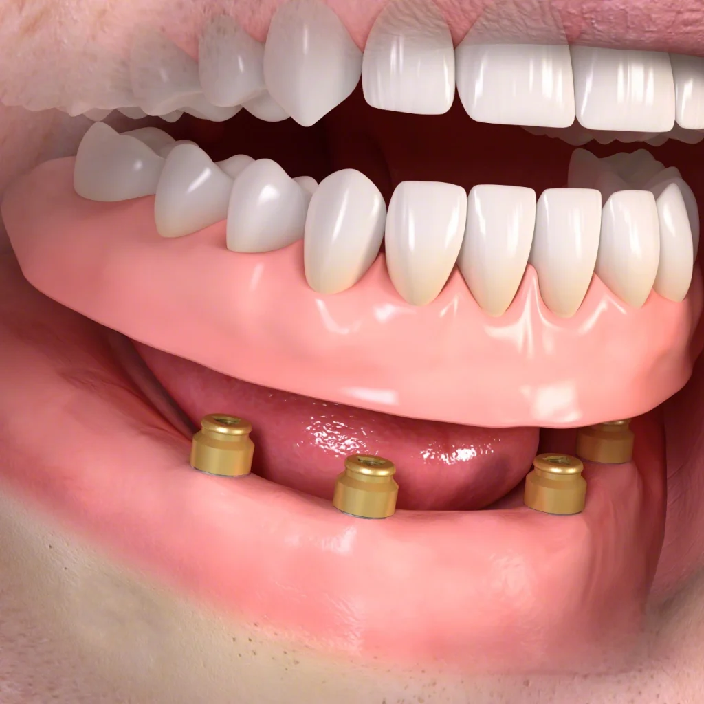 インプラント義歯