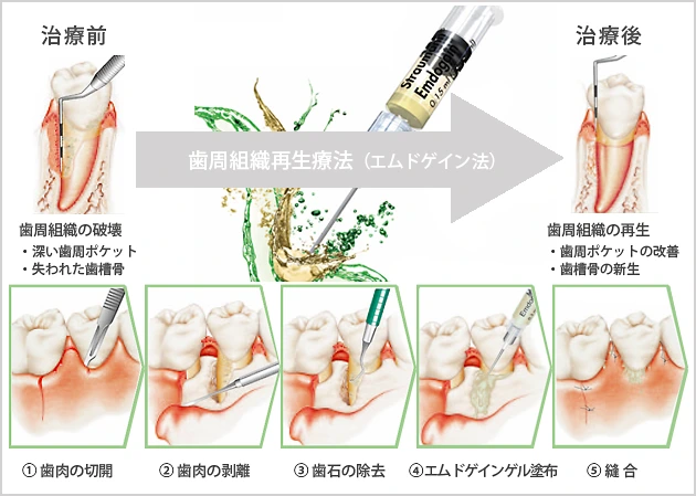 エムドゲイン法のイラスト