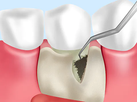 歯科外科治療のイラスト