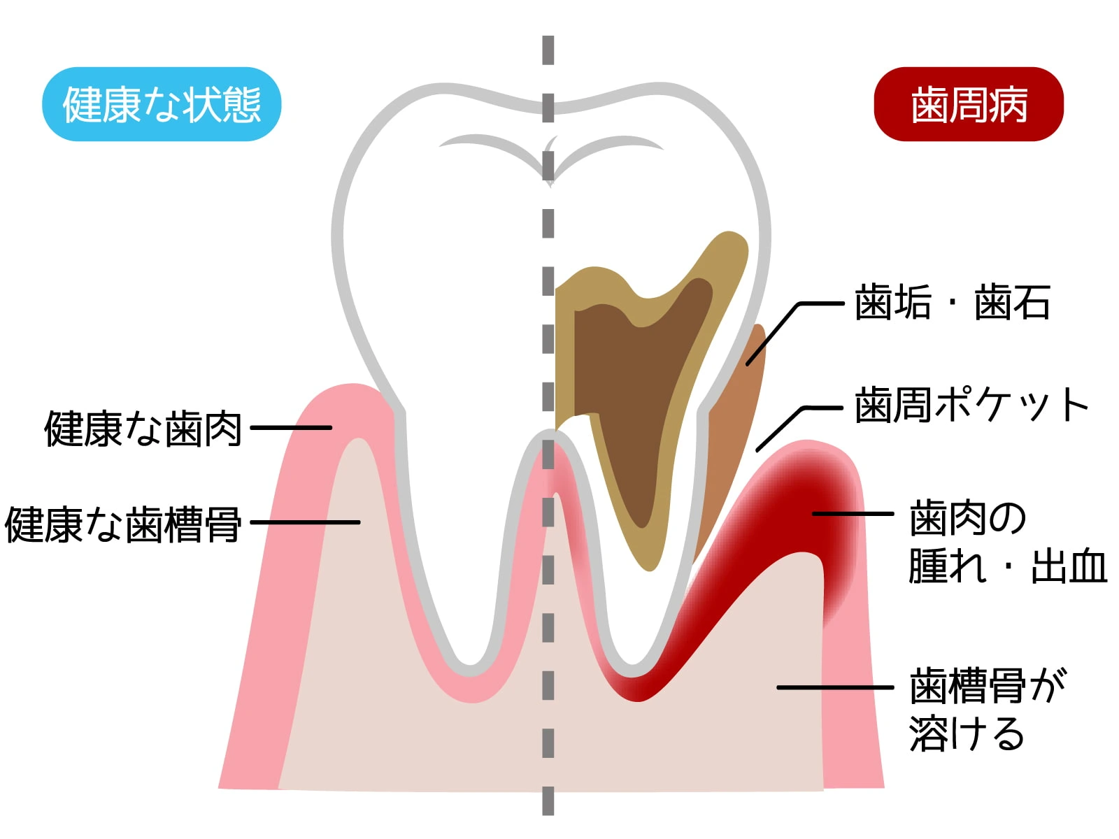 歯周病のイラスト